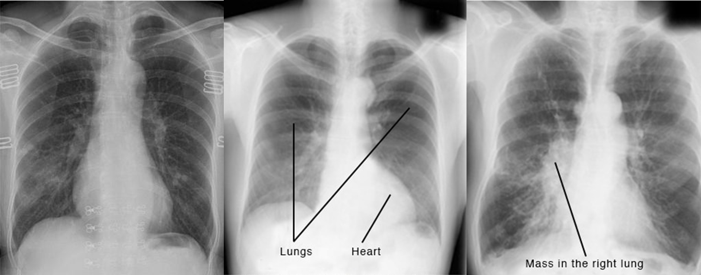 Một số ví dụ về ảnh chụp X-quang ngực